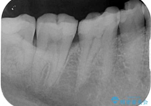 気がついたら歯が欠けていた 奥歯のセラミック補綴の治療前