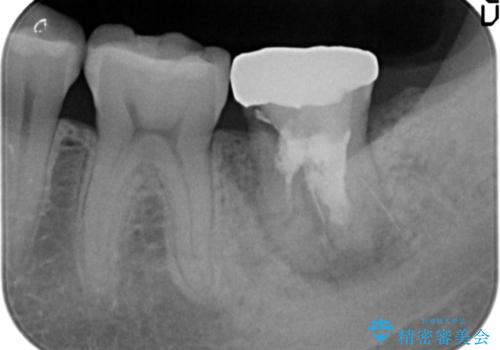 歯が割れた 親知らずの移植 30代女性の治療前