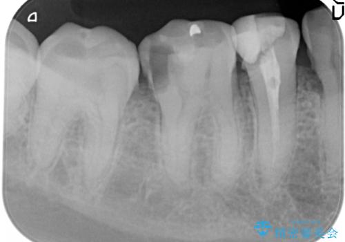 虫歯治療をしたい セラミック治療の治療前