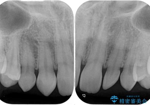 前歯の奇形歯 オールセラミッククラウンによる審美歯科治療の治療前
