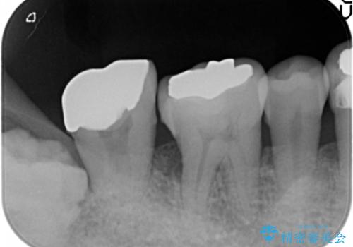 骨を再生させて歯周病を治す　再生療法　50代男性の治療前