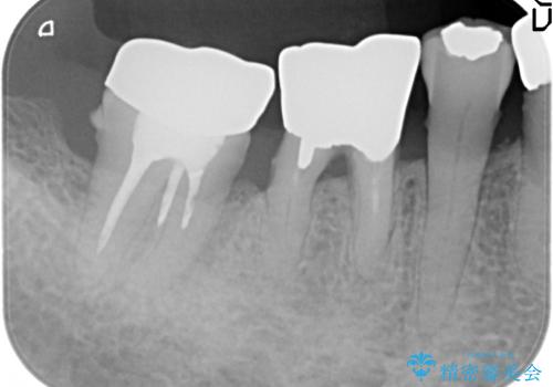 歯ぐきから血が出る、歯ぐきが腫れている 80代女性の治療前
