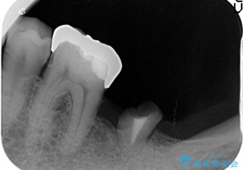 咬合平面を揃え、早期接触・干渉を防ぐ補綴治療の治療前