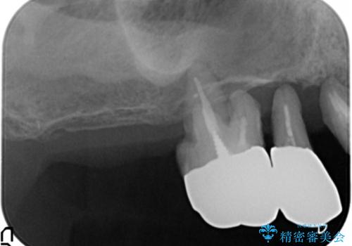 歯がぐらぐら 上顎洞底挙上術を併用した奥歯のインプラント 50代男性の治療前