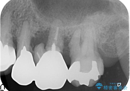 歯ぐきから血が出る、歯ぐきが腫れている 80代女性の治療前
