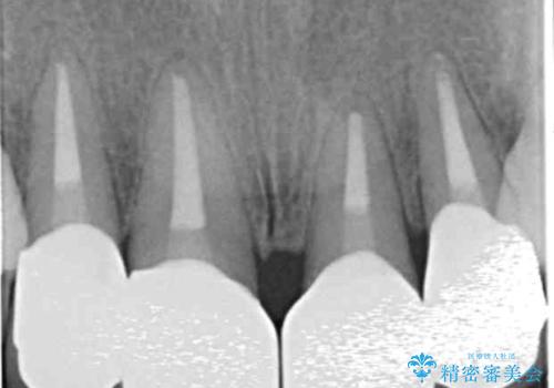 [前歯のグラつき]　根本的な前歯の審美治療を希望の治療後