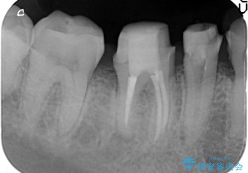 虫歯治療をしたい セラミック治療の治療中