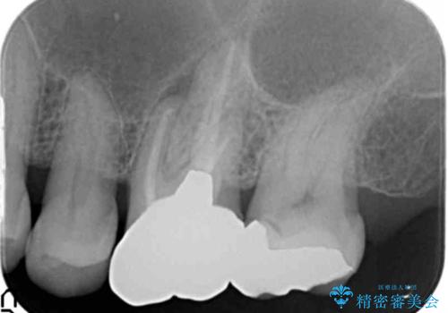 奥歯がわれている ソケットリフトを併用した奥歯のインプラント 60代男性の治療前