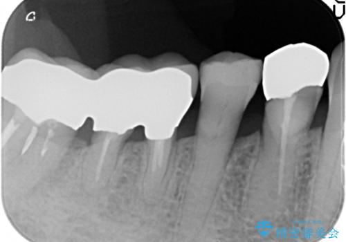 歯ぐきから血が出る、歯ぐきが腫れている 80代女性の治療後