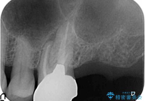 奥歯がわれている ソケットリフトを併用した奥歯のインプラント 60代男性の治療前