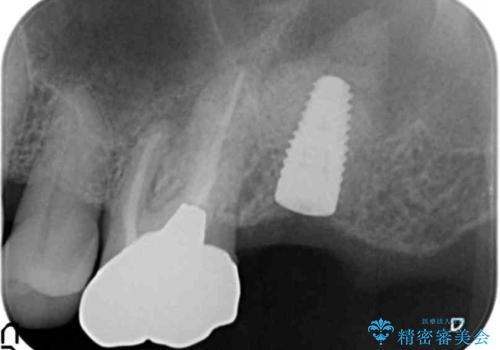 奥歯がわれている ソケットリフトを併用した奥歯のインプラント 60代男性の治療中