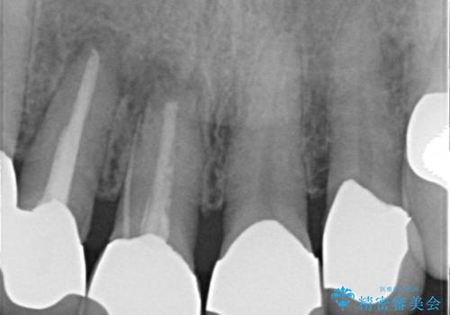 状況に応じた前歯の補綴計画の治療前