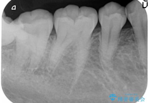 親知らずを起因とする虫歯治療の治療中