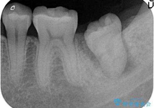 歯が割れた 親知らずの移植 30代女性の治療中