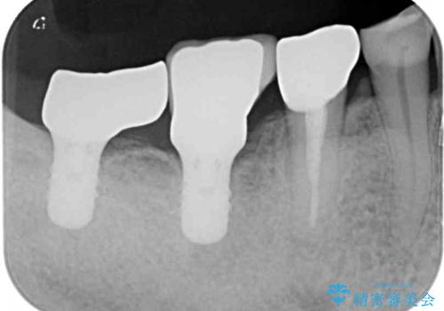 かけて金属の見えてしまったセラミック 強化セラミックでの補綴治療の治療後