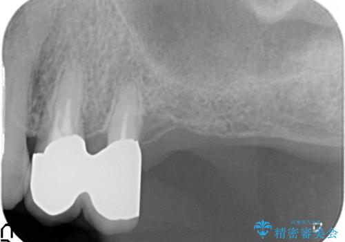 歯ぐきから血が出る、歯ぐきが腫れている 80代女性の治療後