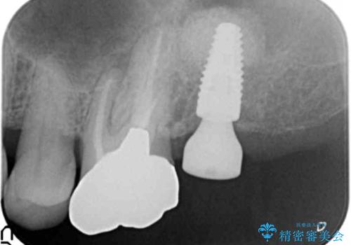 奥歯がわれている ソケットリフトを併用した奥歯のインプラント 60代男性の治療中