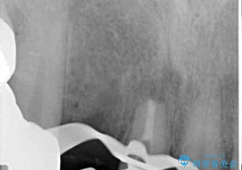 状況に応じた前歯の補綴計画の治療前