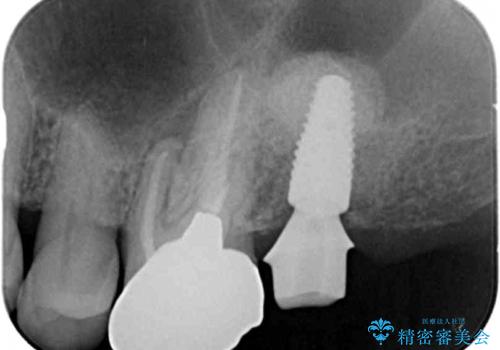 奥歯がわれている ソケットリフトを併用した奥歯のインプラント 60代男性の治療後