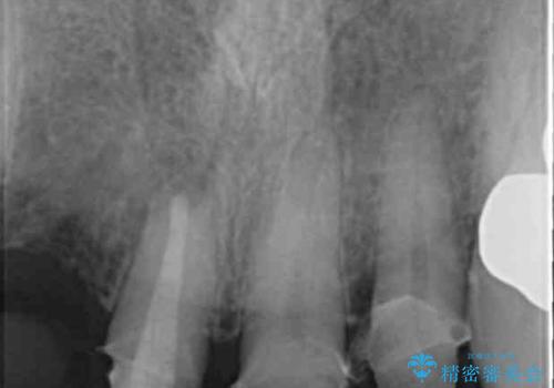 状況に応じた前歯の補綴計画の治療前