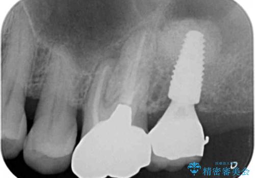 奥歯がわれている ソケットリフトを併用した奥歯のインプラント 60代男性の治療後