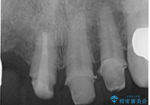 状況に応じた前歯の補綴計画の治療中