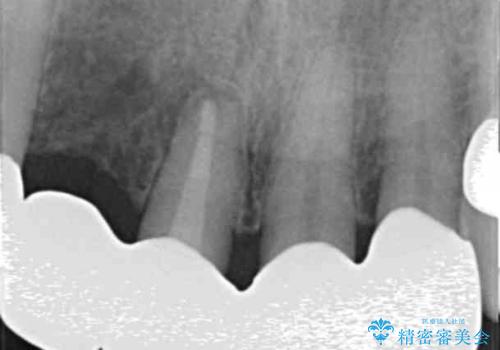 状況に応じた前歯の補綴計画の治療後