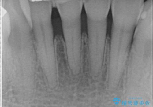 前歯がかけた、ぐらぐらする 60代女性の治療前