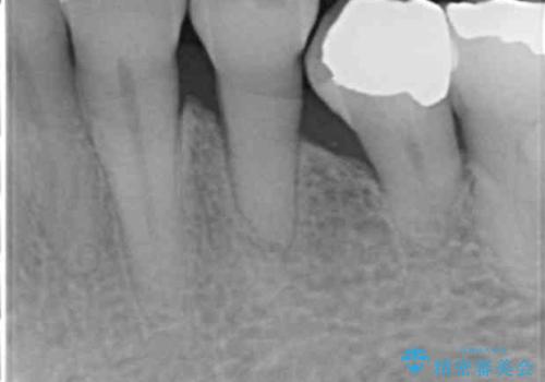 前歯がかけた、ぐらぐらする 60代女性の治療前