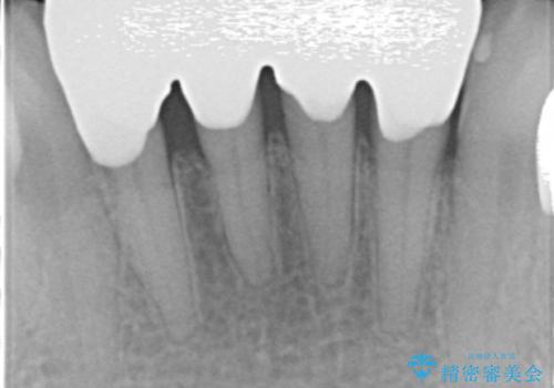 前歯がかけた、ぐらぐらする 60代女性の治療後