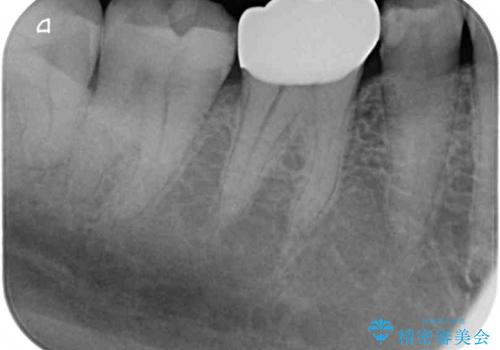 気がついたら歯が欠けていた 奥歯のセラミック補綴の治療後