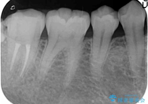 親知らずを起因とする虫歯治療の治療中