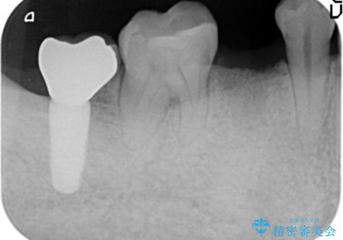 予算を抑えてしっかりとしたインプラント治療 30代男性の治療前