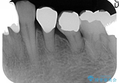 前歯がかけた、ぐらぐらする 60代女性の治療後