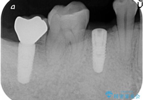 予算を抑えてしっかりとしたインプラント治療 30代男性の治療中