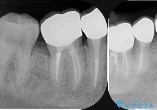 虫歯治療をしたい セラミック治療の治療後