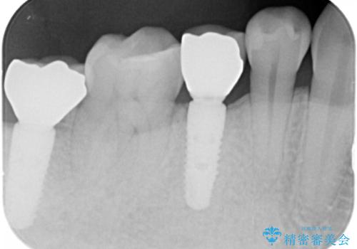予算を抑えてしっかりとしたインプラント治療 30代男性の治療後
