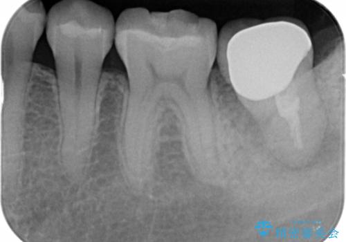 歯が割れた 親知らずの移植 30代女性の治療後