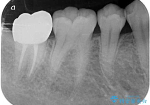 親知らずを起因とする虫歯治療の治療後
