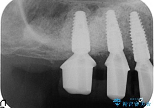 歯がぐらぐら 上顎洞底挙上術を併用した奥歯のインプラント 50代男性の治療中