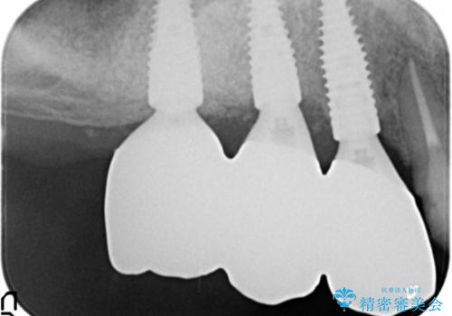 歯がぐらぐら　上顎洞底挙上術を併用した奥歯のインプラント　50代男性の治療後