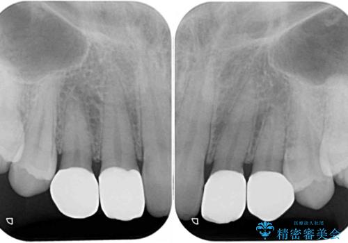前歯の奇形歯 オールセラミッククラウンによる審美歯科治療の治療後
