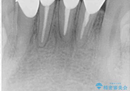 強い咬み合わせで削れた前歯 セラミッククラウンで自然な形にの治療後