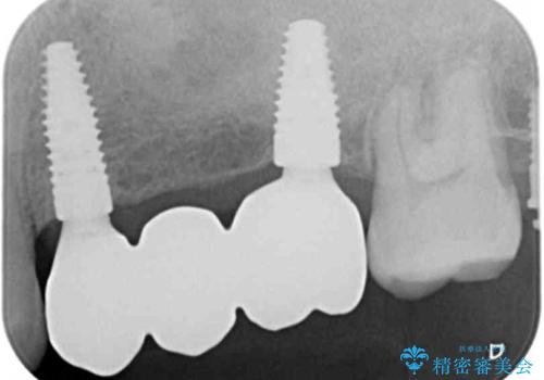 咬合平面を揃え、早期接触・干渉を防ぐ補綴治療の治療後