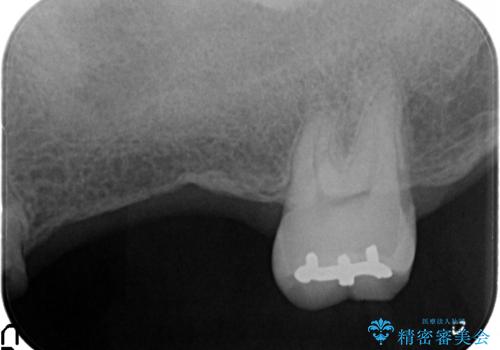 咬合平面を揃え、早期接触・干渉を防ぐ補綴治療の治療前