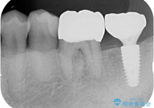 咬合平面を揃え、早期接触・干渉を防ぐ補綴治療の治療後
