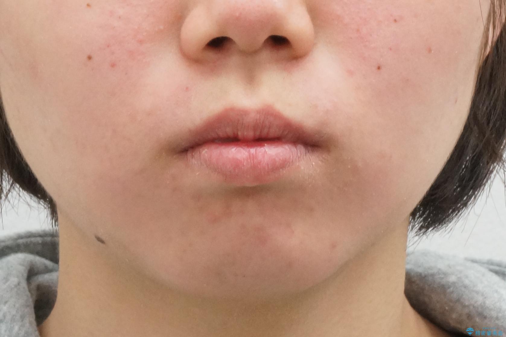 20代女性 出っ歯 口元を引っ込めたいの治療前(顔貌)