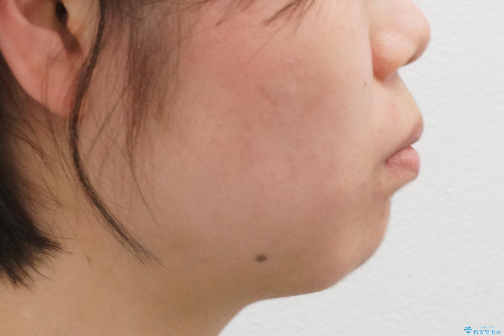 20代女性 出っ歯 口元を引っ込めたいの治療前(顔貌)