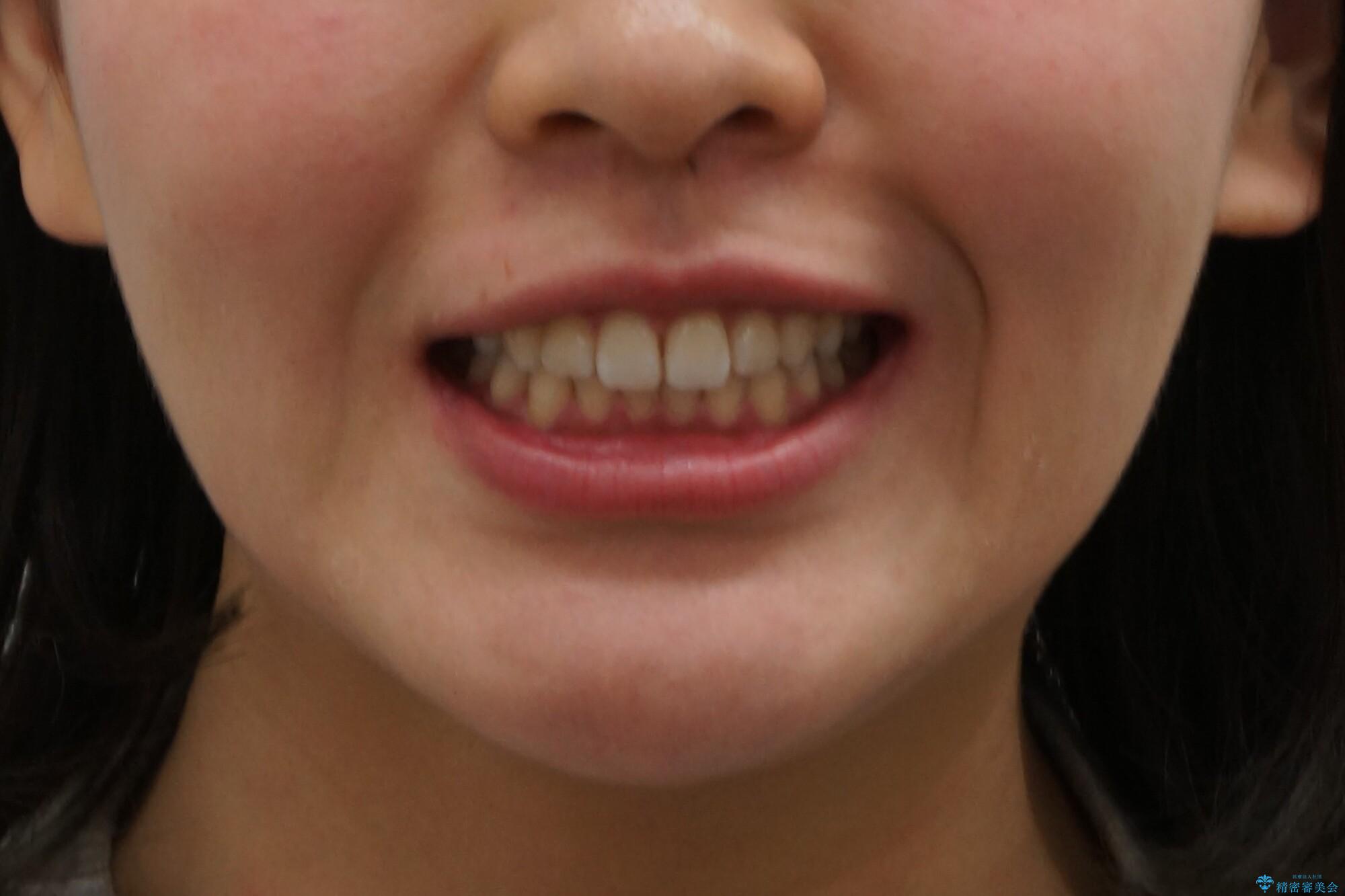 出っ歯 インビザラインで歯を抜かない治療の治療後(顔貌)