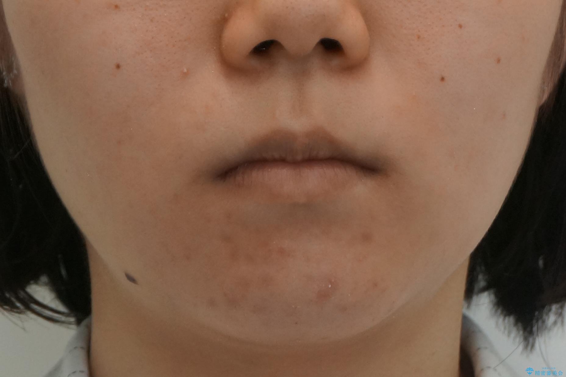 20代女性 出っ歯 口元を引っ込めたいの治療後(顔貌)